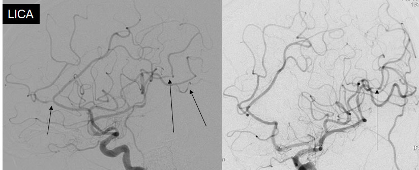 DSA vasculitis